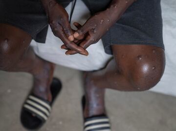 República Democrática del Congo reporta más de mil casos nuevos de mpox en la última semana