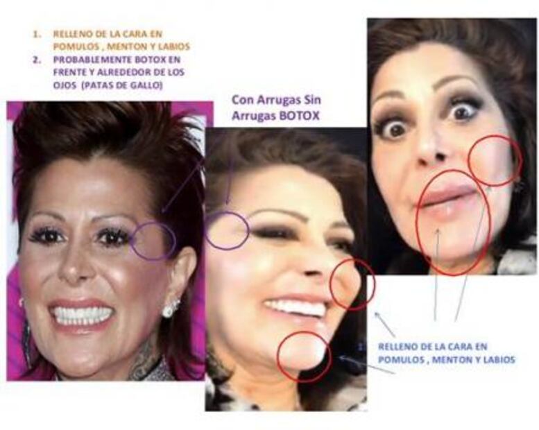 El bótox cambia la cara de Guzmán 