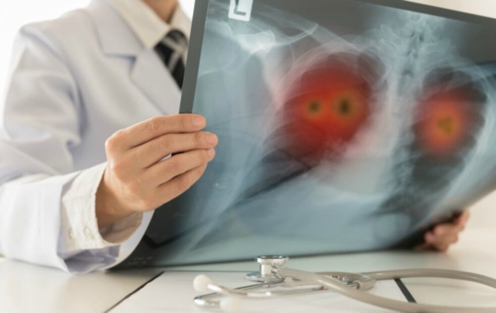 El cáncer de pulmón es prevenible en el 80% de los casos. Foto: Archivo / EL UNIVERSAL 