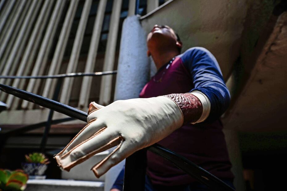 Pedro sufrió quemaduras de tercer grado en el pecho, brazo, mano y dedos izquierdos, y también internas. Foto: Diego Simón / El Universal