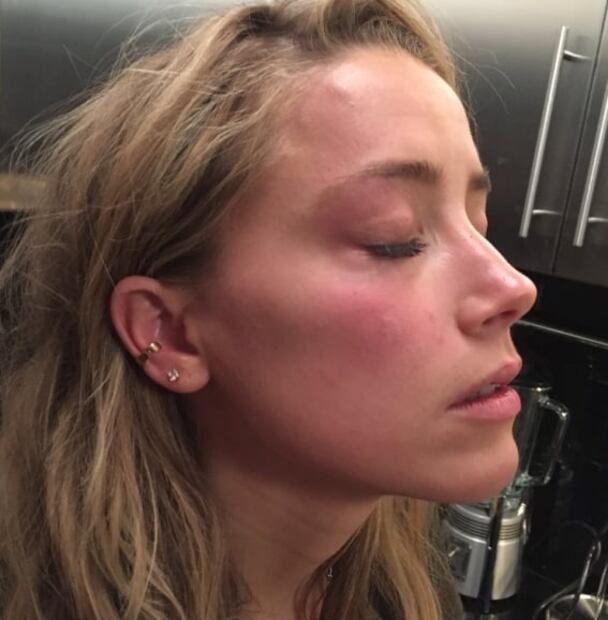 Los misteriosos golpes de Amber Heard: ella culpa a Johnny Depp, pero él lo niega 