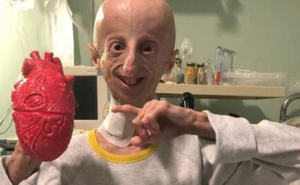 Fallece Sammy Basso, científico italiano con progeria que investigaba sobre su enfermedad