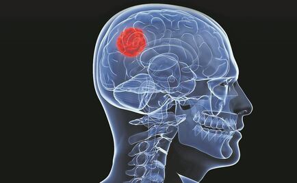 Fármaco disminuye crecimiento de tumores cerebrales