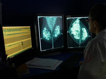 Tecnología 3D para reconstruir senos en mujeres con cáncer