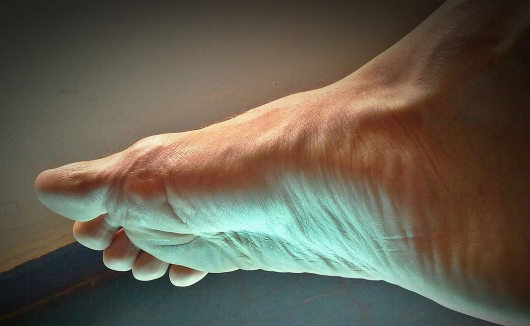 Tobillo inflamado. Fuente: Pixabay