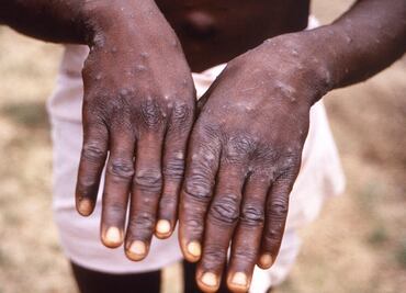 Estudio revela que 95% de casos de viruela del mono analizados fueron por transmisión sexual pero no es la única vía