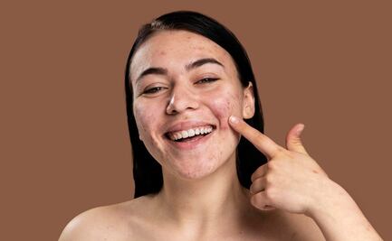 Cómo quitar los granos de la cara correctamente