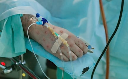 Viruela del mono: Ssa espera autorización de Cofepris para uso de emergencia de vacuna contra Mpox