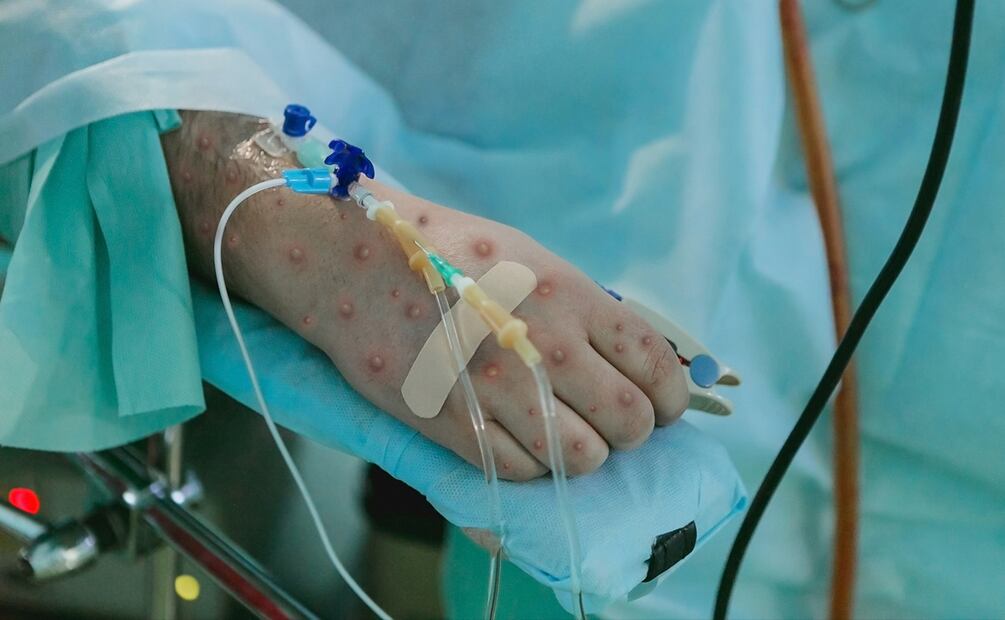 Paciente infectada con Viruela del Mono. / Foto: iStock.