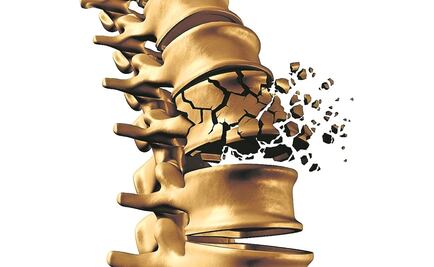 Hoy es el Día Mundial de la Osteoporosis