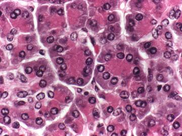 Cáncer de páncreas, el más letal y difícil de diagnosticar