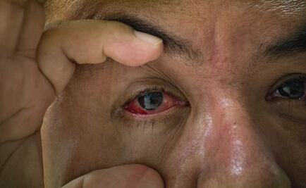 Durante la canícula, especialistas sugieren aseo de párpados 