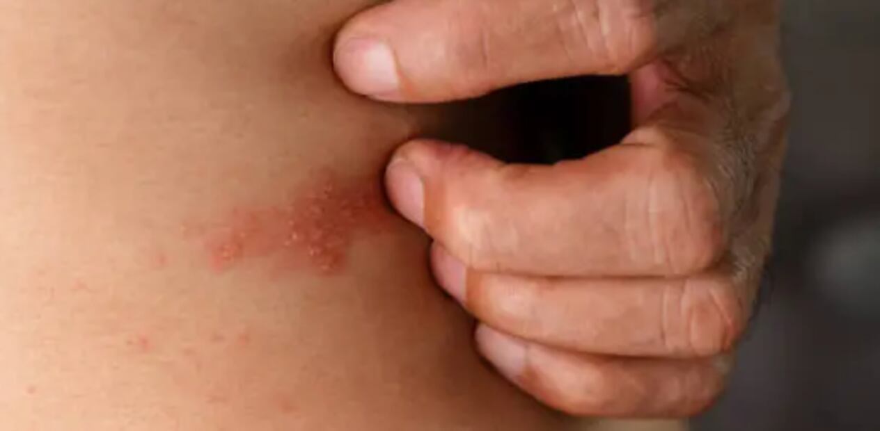 Herpes zóster. Foto: Pixabay