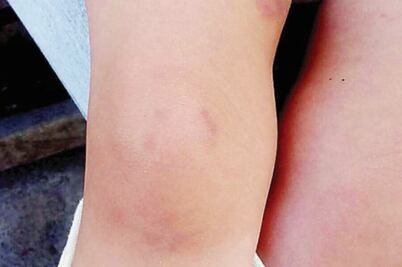 Muerden a bebé 16 veces en guardería