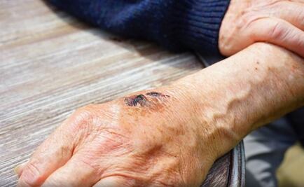 ¿Por qué las heridas tardan más en curarse con la edad?