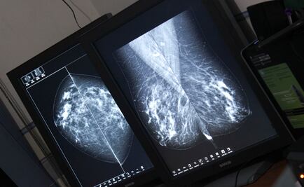 Prevé ISSSTE brindar 3 mil 300 mastografías antes de 2018