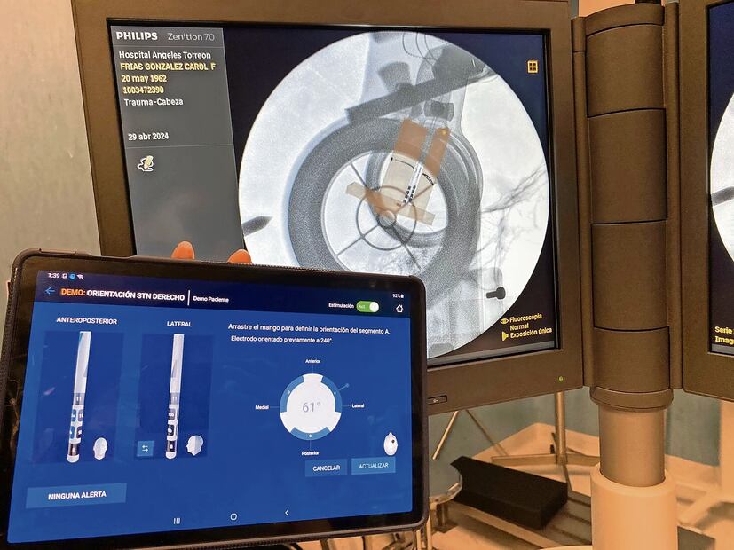 La estimulación cerebral profunda es un tratamiento con el que se busca regular un circuito que no funciona. Foto: Especial