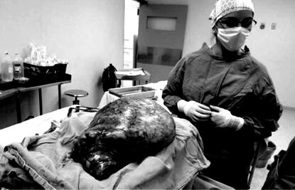 Extirpan tumor de 17 kilos a una mujer en Durango