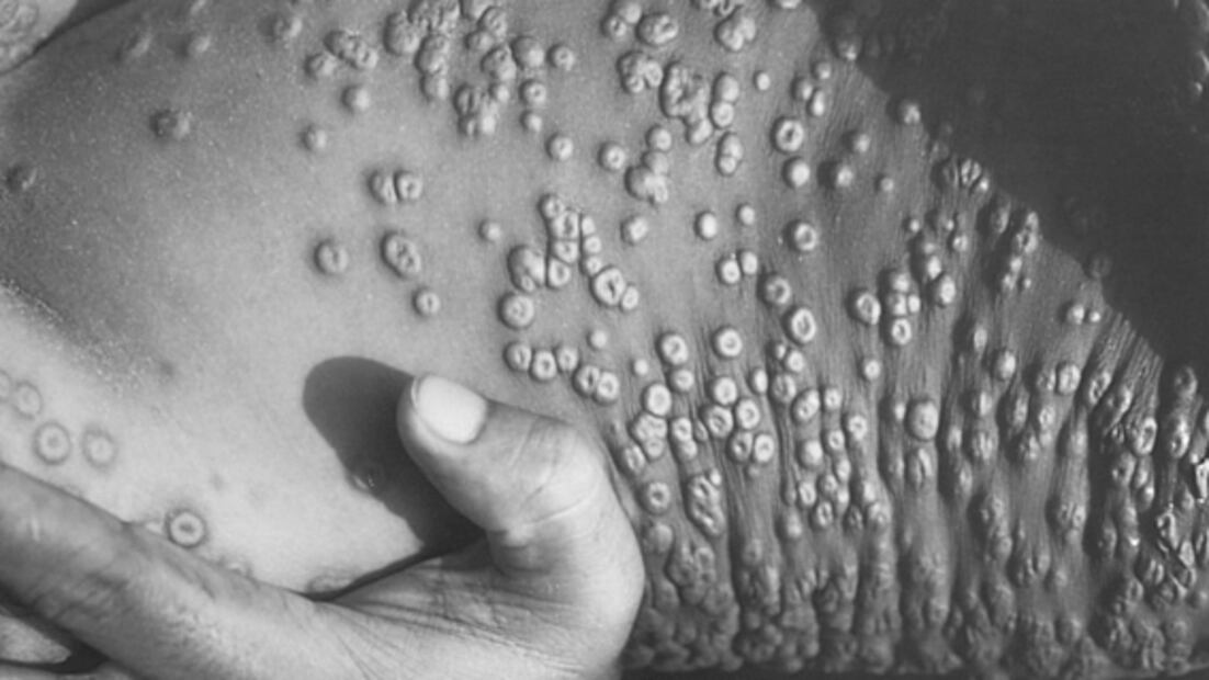 Viruela del mono: en qué se diferencia de la devastadora viruela humana