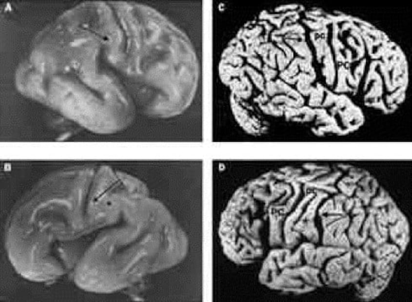 ¿En dónde está y qué pasó con el cerebro de Albert Einstein?
