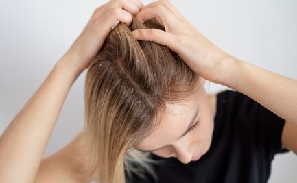 La razón por la que te pica el cuero cabelludo