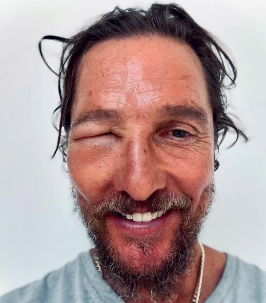 Matthew McConaughey muestra cómo quedó su rostro tras el piquete de una abeja.