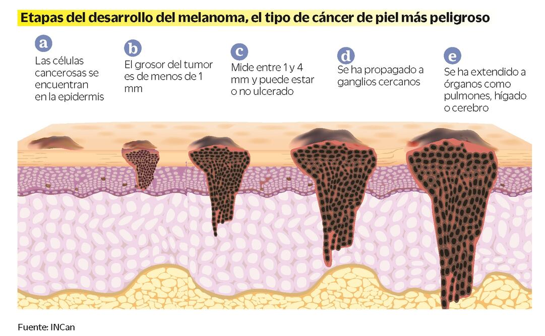 Aumenta cáncer de piel en población más joven