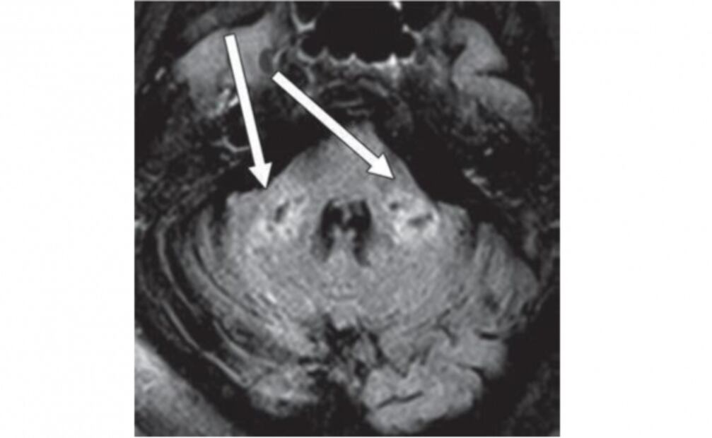 El Covid-19 se relaciona con una inflamación en el cerebro: estudio
