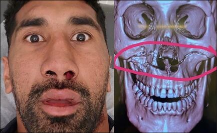 La terrible fractura de un jugador de rugby 