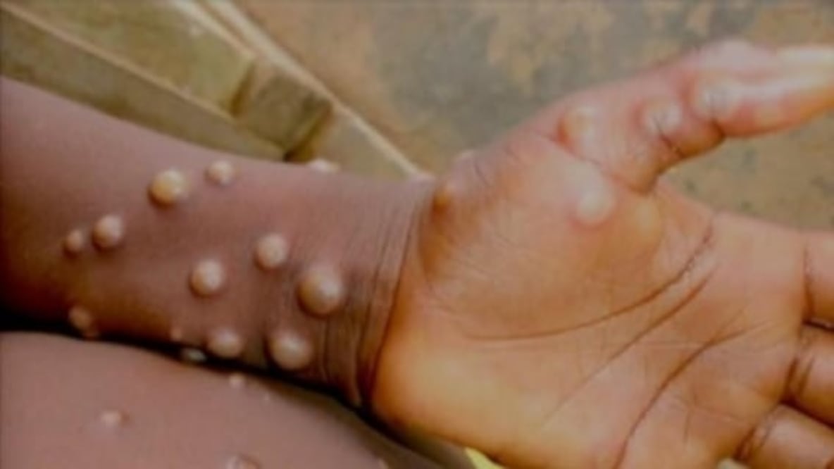 Esta es la segunda vez en dos años que se considera que esta enfermedad infecciosa puede convertirse en una amenaza sanitaria internacional,