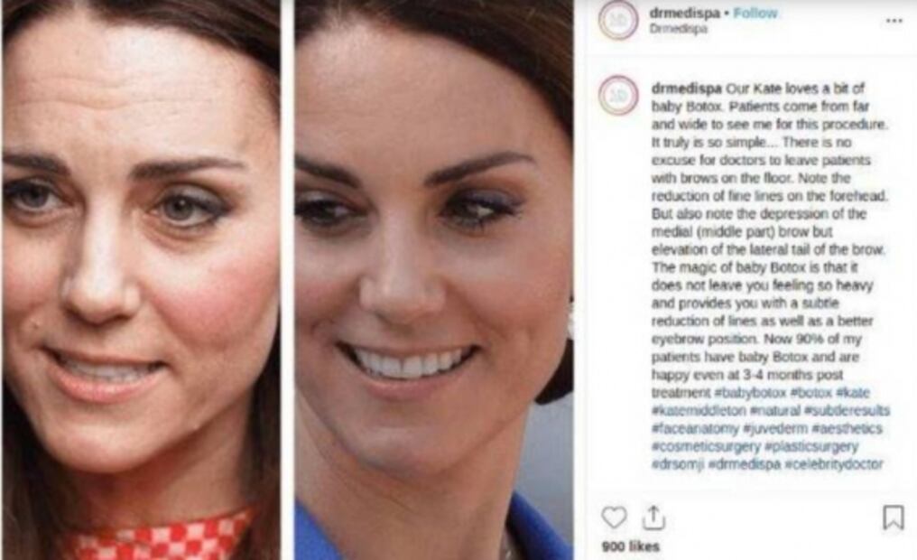 Usuarios en redes sociales afirman que Kate Middleton podría utilizar botox