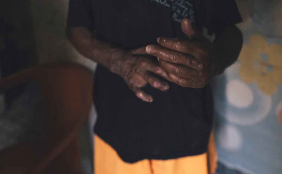 Gerhard Henrik Armauer Hansen descubrió la bacteria que causa la enfermedad en 1873 - Foto: Joshua E. Cogan