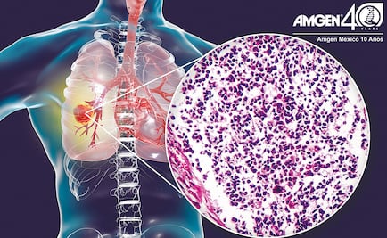El cáncer de pulmón es prevenible en el 80% de los casos  