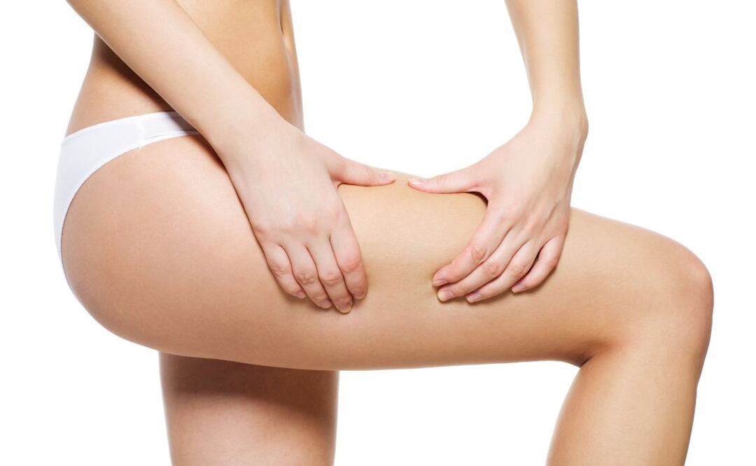 Abedul y celulitis. Fuente: Freepik