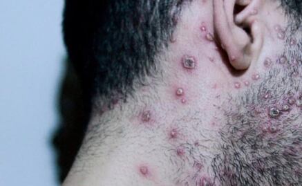 OMS: van más de 50 mil casos de viruela del mono en todo el mundo