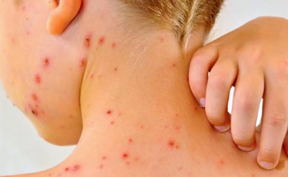 Protuberancias provocadas por sarampión Foto: Especial