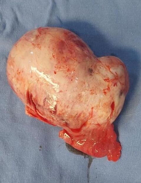 Verónica del Castillo muestra tumor benigno que le extirparon del ovario