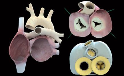 Muere paciente con corazón artificial en Francia