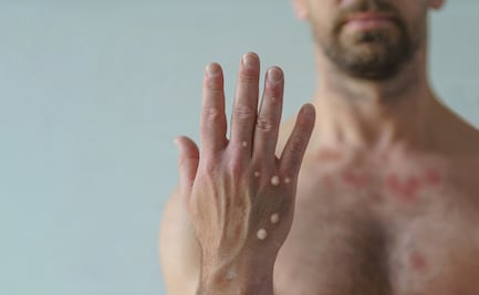 Confirman primera muerte por Mpox en Jalisco; hay 62 casos registrados en el estado en lo que va del año