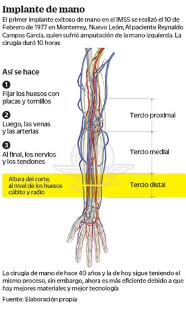Proeza: 41 años del primer reimplante de mano 