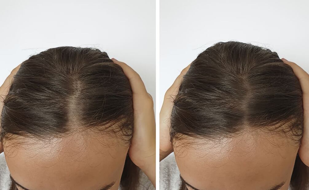 Las mejores clínicas en CDMX combinan tecnología, experiencia médica y atención integral para combatir la alopecia