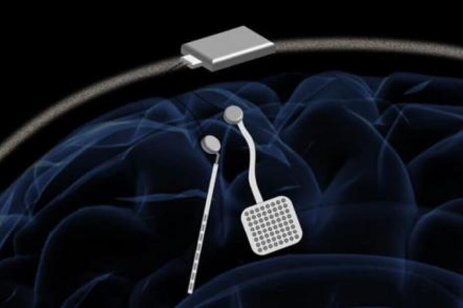 Desarrollan marcapasos para el cerebro, útil en trastornos neurológicos