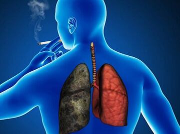El cáncer de pulmón sigue su desconocido y "desalentador" avance en América