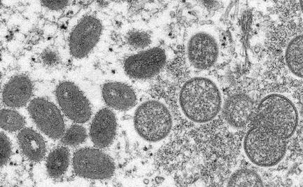 Brasil investiga dos casos sospechosos de viruela del mono