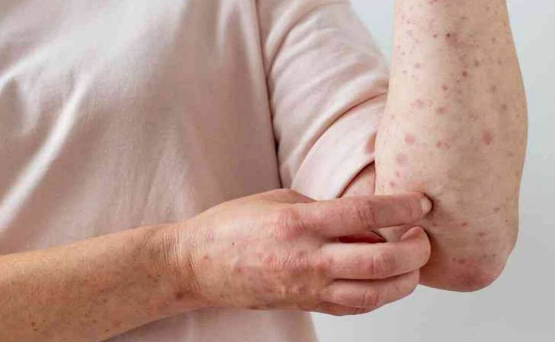 Salud reporta reducción en curva epidémica de viruela símica