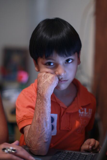 César Fernando Díaz Lucero tenía tres años cuando el incendio lo alcanzó hasta su cama; sufrió quemaduras de segundo y tercer grado en 40% de su cuerpo.