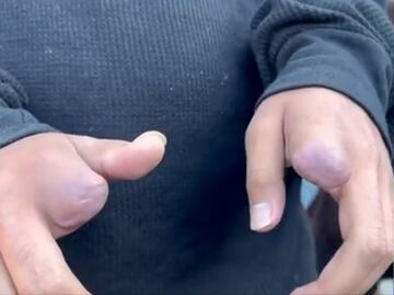 Mutilan dedos a joven de 16 años tras negarse a vender droga en Acapulco