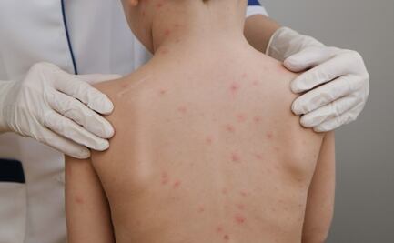 Confirman 13 nuevos casos de sarampión en Durango