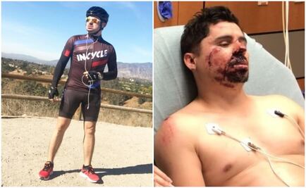 Reconstruyen mejilla de Larry Hernández tras accidente en bicicleta 