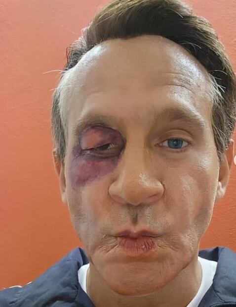 ¡Con el ojo morado! Arath de la Torre queda "igualito" que Alfredo Adame